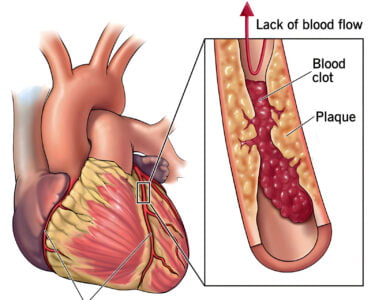 Coronary Artery Disease