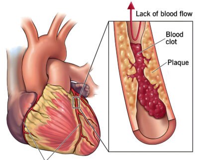 Coronary Artery Disease