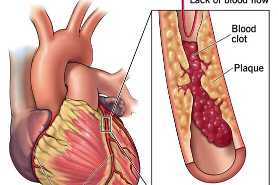 Coronary Artery Disease