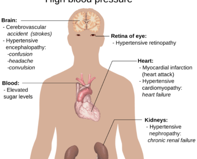 hypertension symptoms