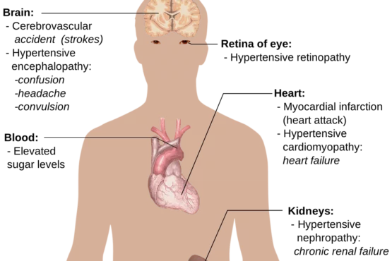 hypertension symptoms