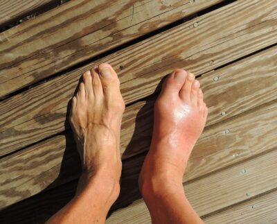 how to stop gout pain at night