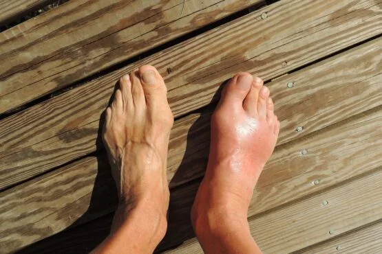 how to stop gout pain at night